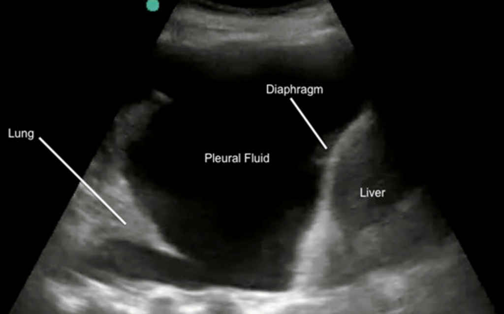 Ultrasound Pleural Effusion
